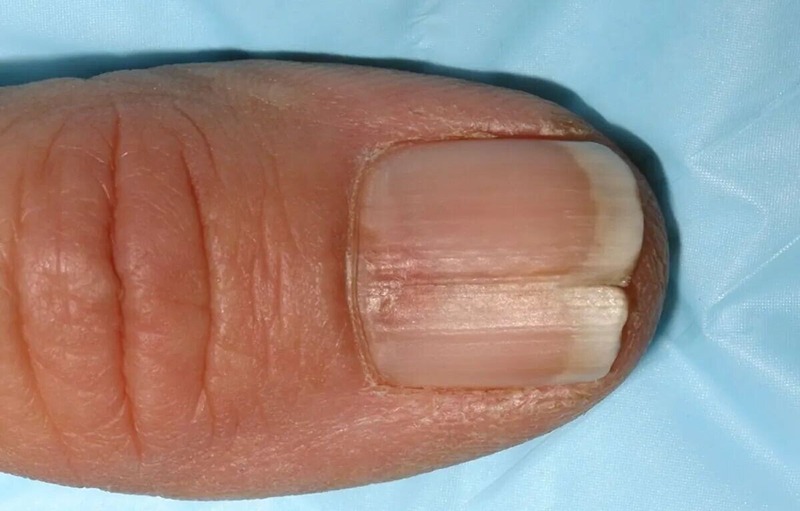 How Fungus Can Cause Nail Separation Otherwise Known as Onycholysis