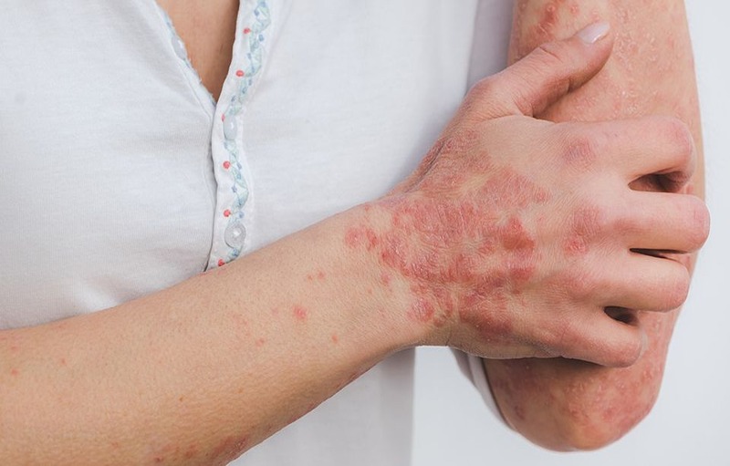 Psoriasis And Mental Health