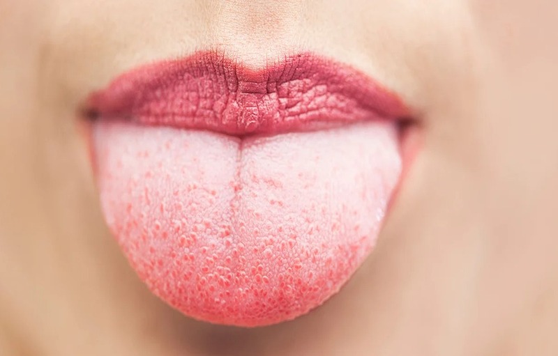 How To Permanently Get Rid Of White Tongue On Your Own?