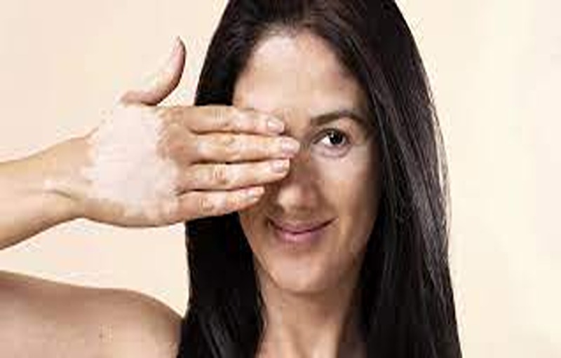 Get rid of the white patches using these excellent home remedies