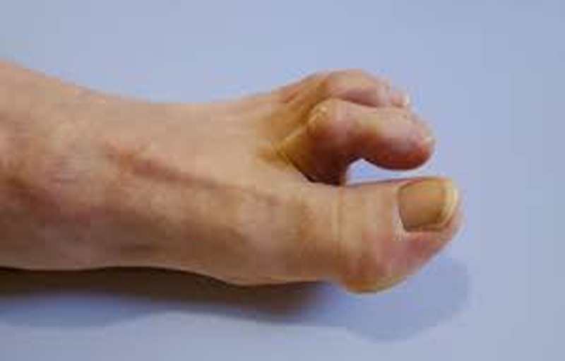 Symptoms, causes and natural remedies of hammer toe