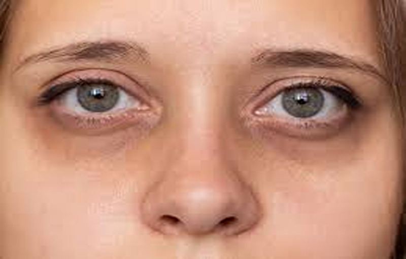 How to Get Rid Of Dark Circles Fast