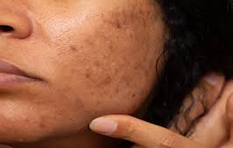Home Remedies For Black Spots On Your Face