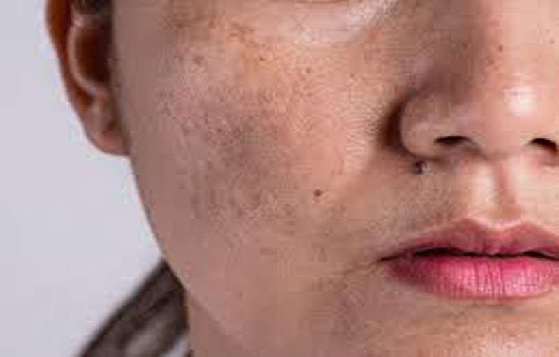 How to Get Rid of Pigmentation