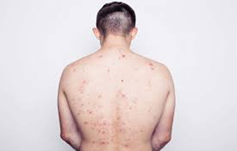 Home Remedies For Back Acne How To Get Rid Of Them