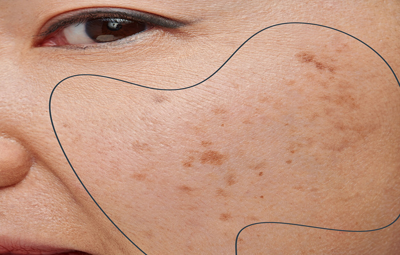 Top 6 Natural Remedies To Reduce Pigmentation And Dark Spots From Skin