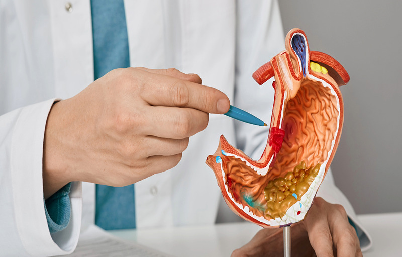 Best 10 Foods To Eat Against Gastric Ulcer