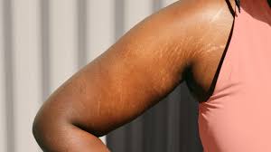 Home Remedies To Get Rid Of Stretch Marks After Pregnancy