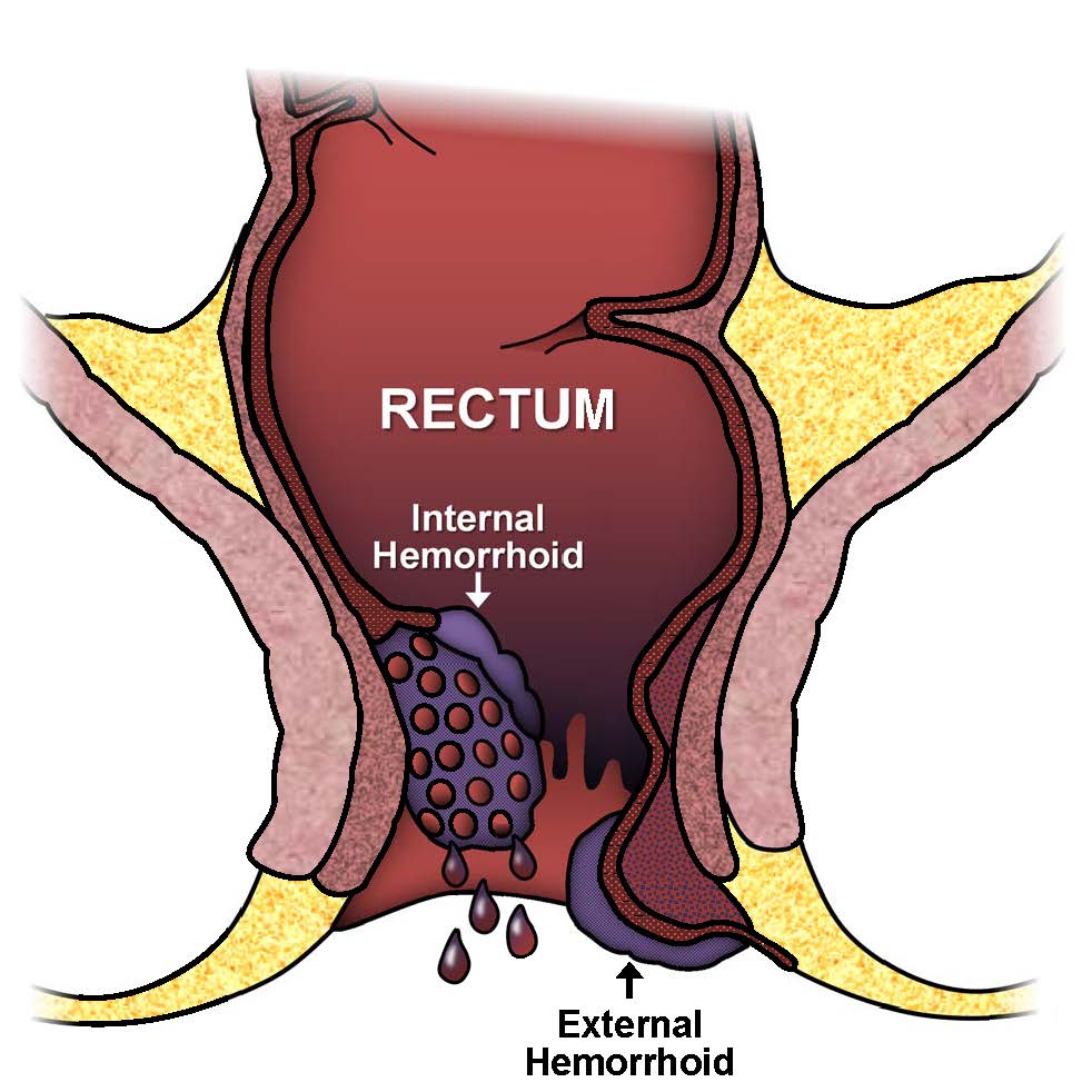 Five tips to help manage hemorrhoid flare-ups and ease discomfort.