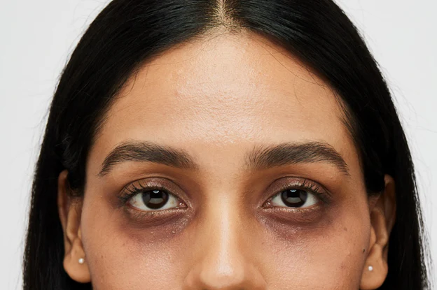 Say Goodbye to Dark Circles: Proven Solutions for a Brighter You.