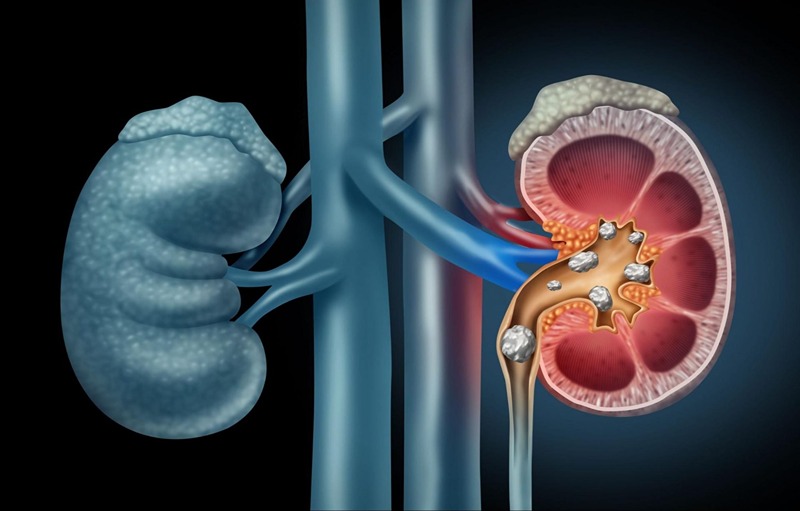 Kidney Stones: Symptoms, Causes, Treatment, and Prevention