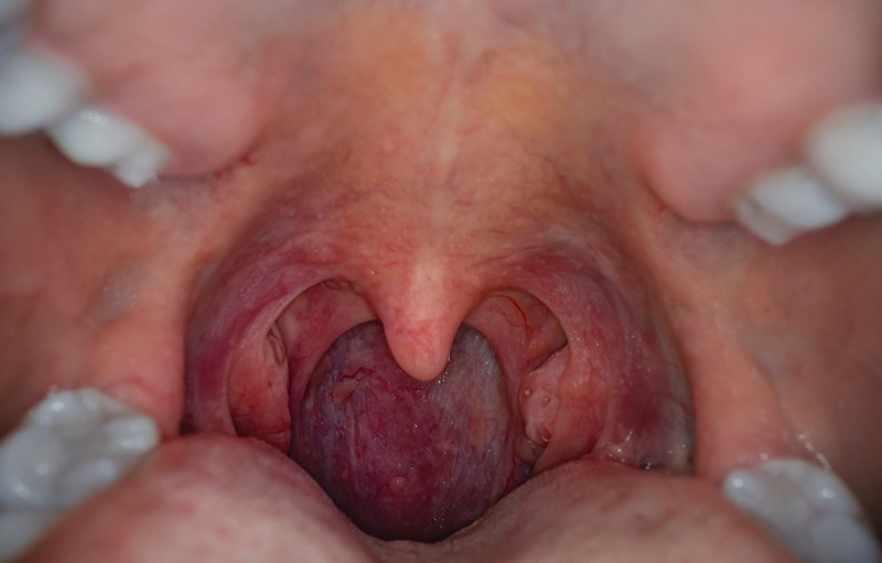 How to Detect Throat Cancer Early: Symptoms & Screening